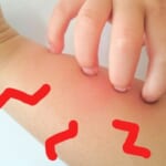 海外旅行で赤ちゃんが虫に刺された！対処と備え